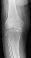 人工膝関節全置換術（手術前レントゲン）