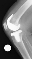人工膝関節全置換術（手術後レントゲン）