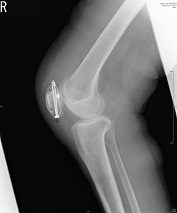 膝蓋骨骨折 手術後レントゲン