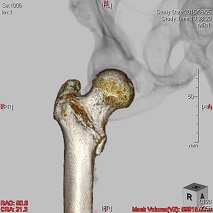 大腿骨転子部骨折 受傷時３DCT画像