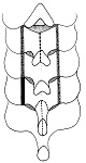 頚椎椎弓形成術